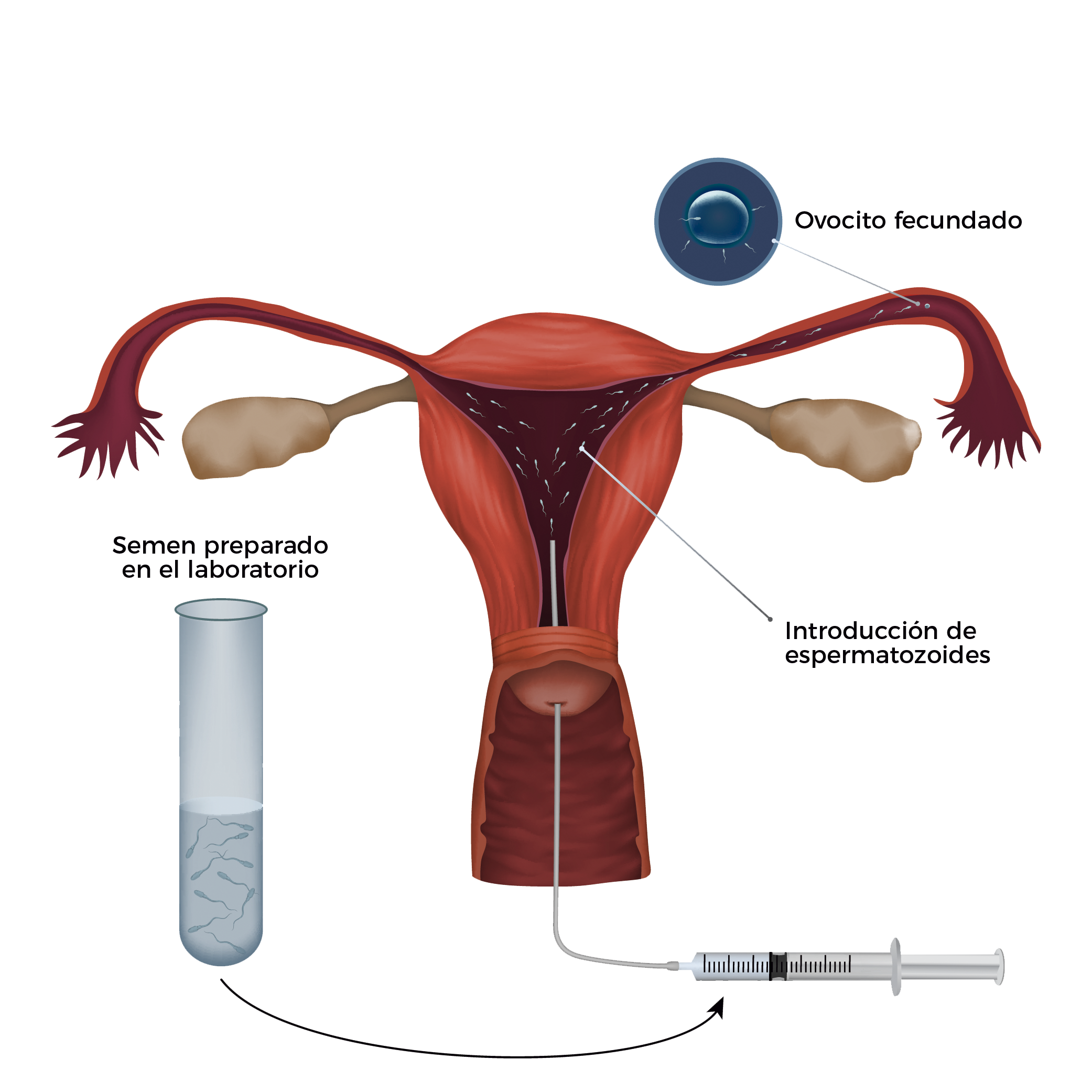 Tratamientos de fertilidad inseminación artificial